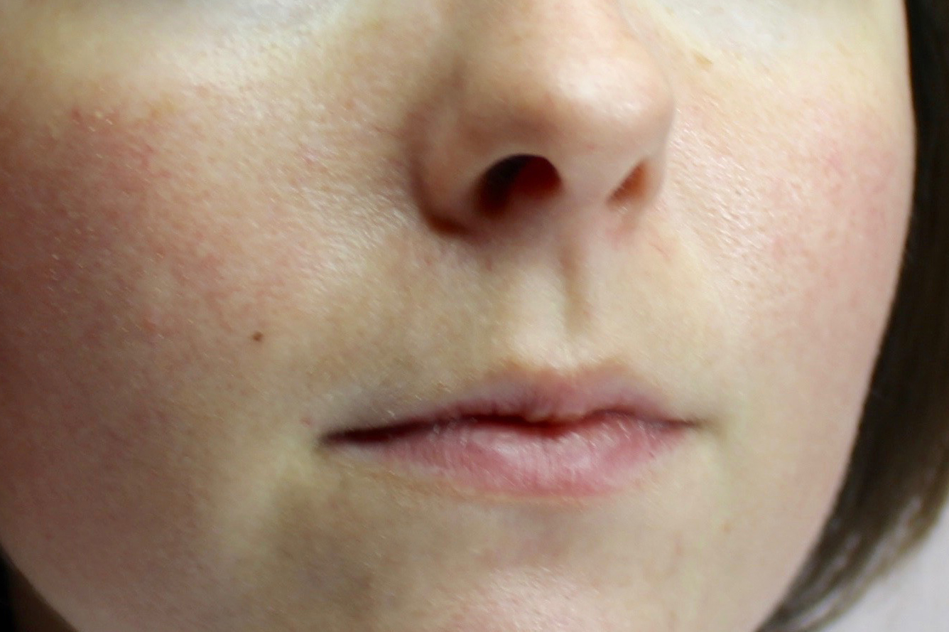 Déborah avant dermopigmentation