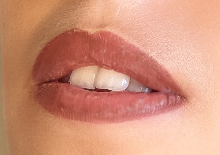 Bouche repulpée après