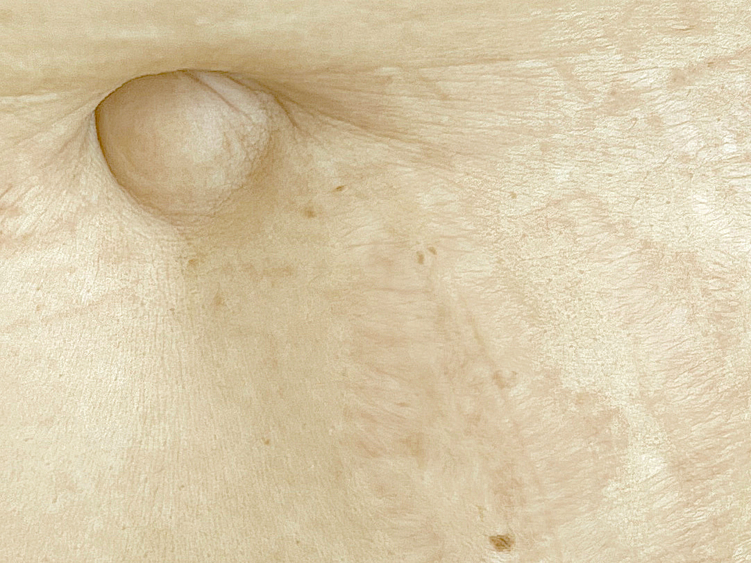 Vergeture après